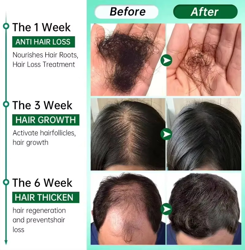 เซรั่มปลูกผม 7 วัน แคปซูลเร่งก - Ingrown Hair Serum บทวิจารณ์และราคา