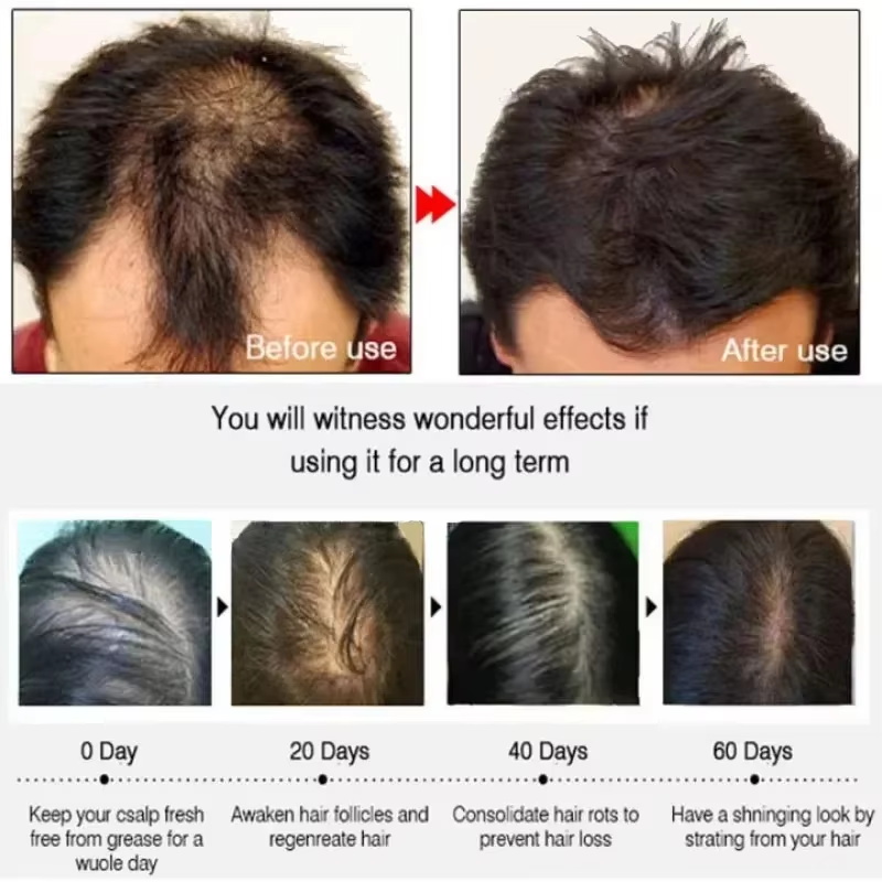 เซรั่มปลูกผม 7 วัน แคปซูลเร่งก - Ingrown Hair Serum บทวิจารณ์และราคา